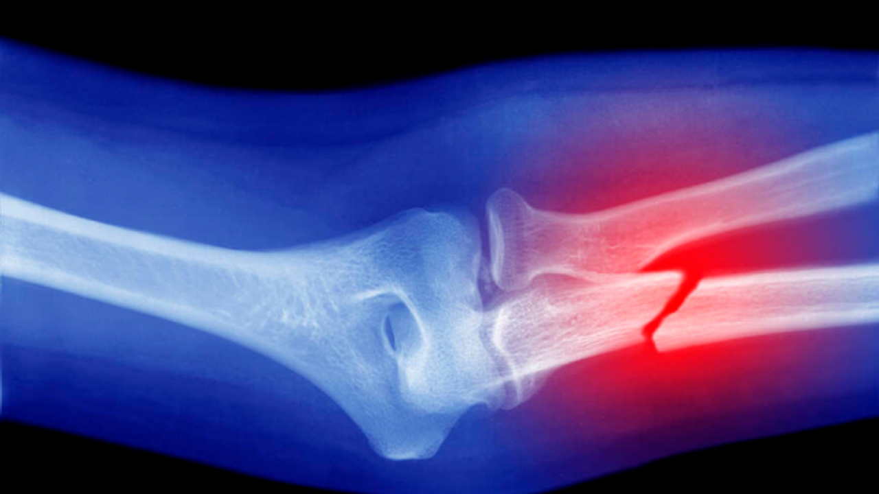 Kırıklardan korunmanın yolları