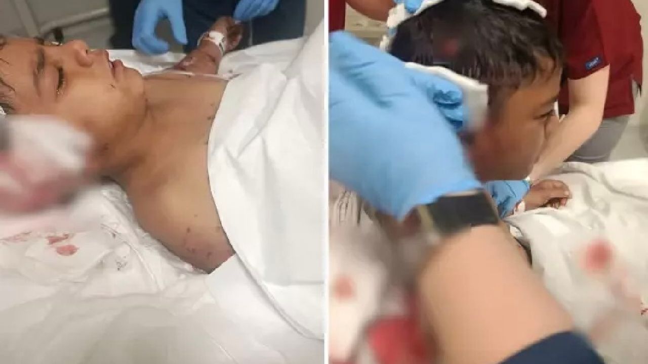 Köpek vahşeti bitmiyor: Saldırıya uğrayan çocuk tedavi altında!