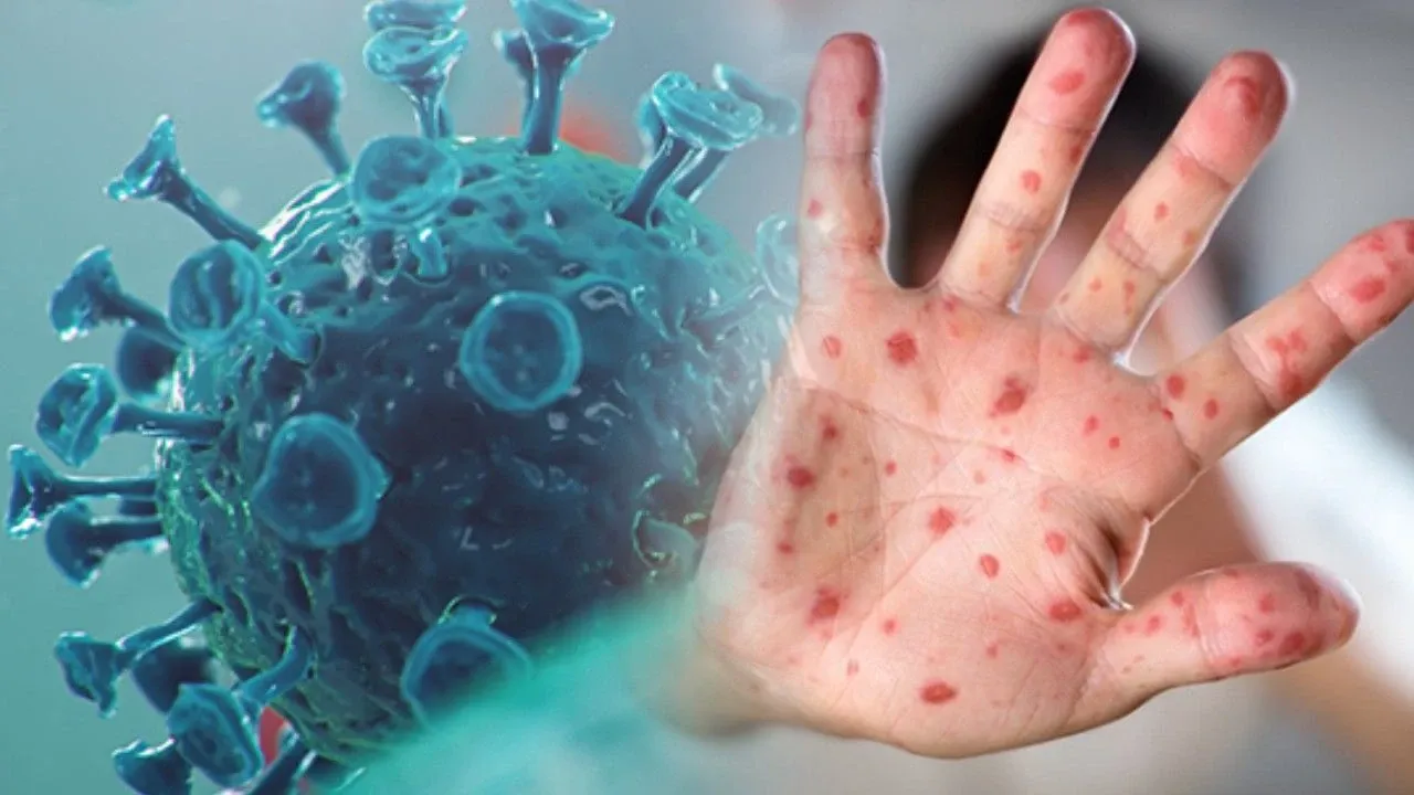 M Çiçeği vaka sayısı yükseliyor