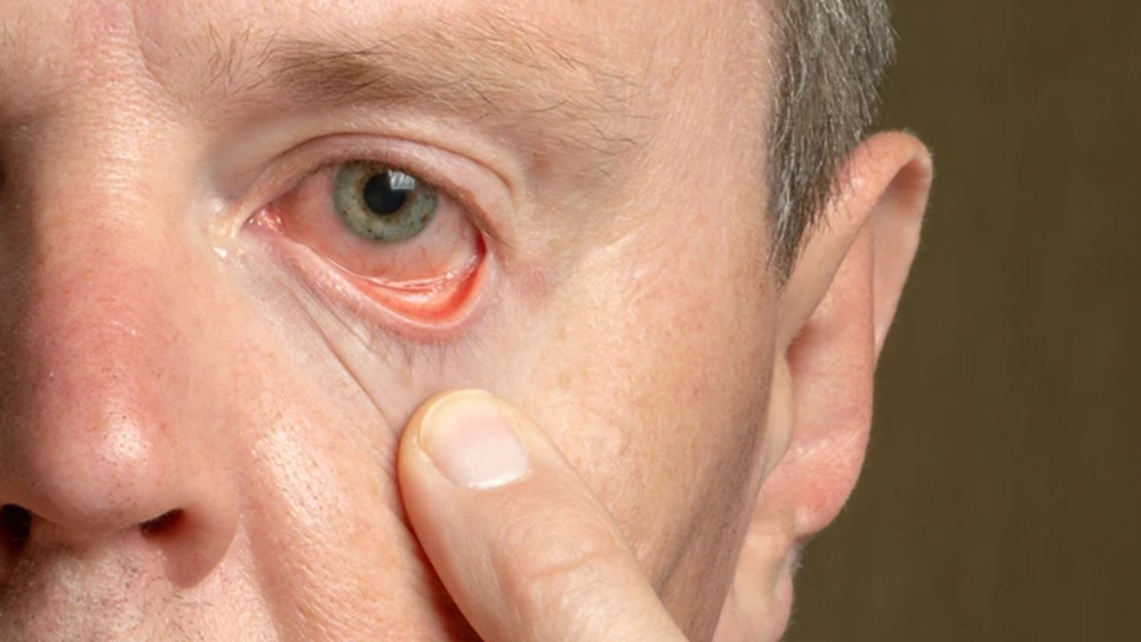 Astigmat nedir, belirtileri nelerdir?  Miyop astigmat nedir?