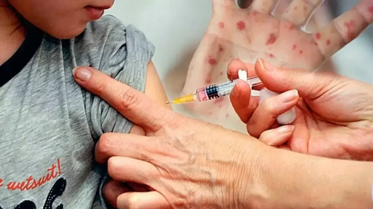 Kızamık şüphesinden 113 çocuk öldü