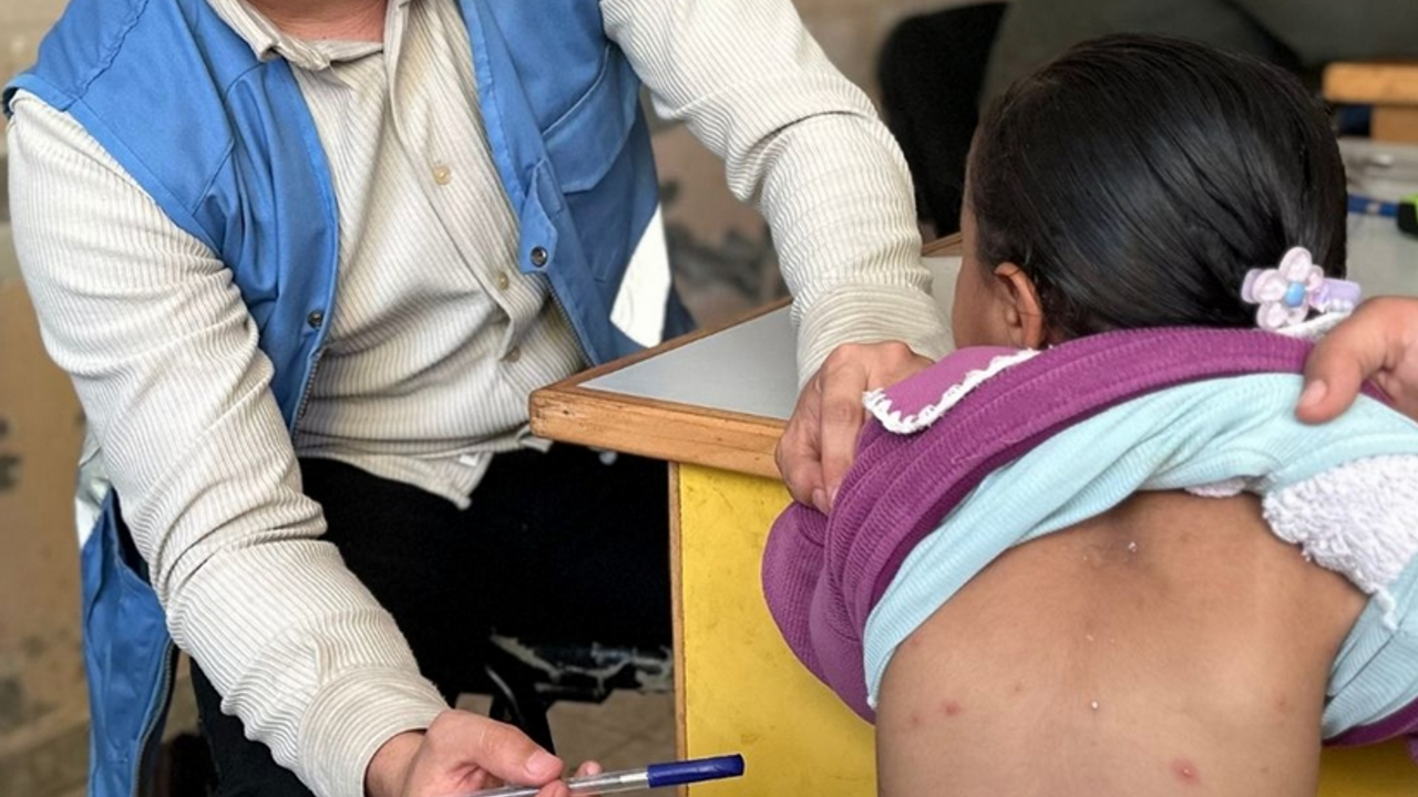 Sağlık alarm veriyor: Gazze'de cilt hastalıkları yayılıyor!