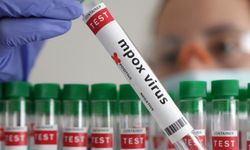 Maymun çiçeği virüsünün yeni türü tespit edildi