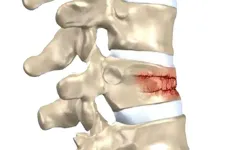 Omurga kırıkları kış aylarında neden artıyor? Uzman isim yanıtladı