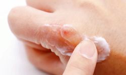 Uzman isimden soğuklarda cilt kuruluğuna karşı 10 tavsiye