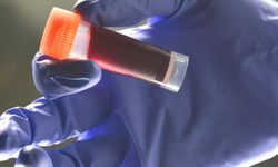 Kan grubunuz erken yaşta inme riskinizi etkiliyor