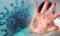 M Çiçeği vaka sayısı yükseliyor