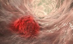 50 yaş altında kolon kanseri vakaları patladı.. Bilim şaşkın