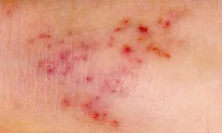 Korkutan Menenjit Yayılımı: Can Kayıpları Artıyor, Vakalar Tırmanışta