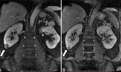 Nefes darlığı şikayetiyle gitti: 8 buçuk kilo tümörle böbreği alındı!