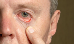 Astigmat nedir, belirtileri nelerdir?  Miyop astigmat nedir?