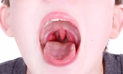 Geniz eti nelere sebep olur deme! Duyunca şaşıracağınız rahatsızlıklar...