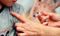 Kızamık şüphesinden 113 çocuk öldü