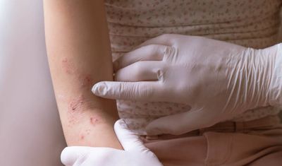 Egzama nedir, neden olur? Egzama bulaşıcı mı?