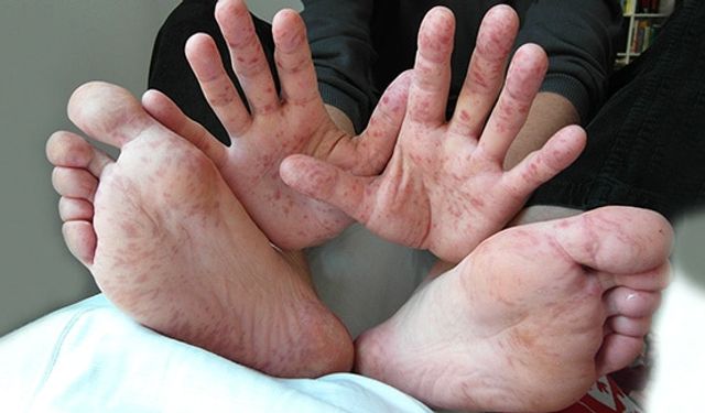 Hastalığın yayılımında bu çok önemli: Aman dikkat!