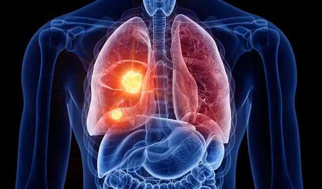 Akciğer kanseri riskini artıran faktörler