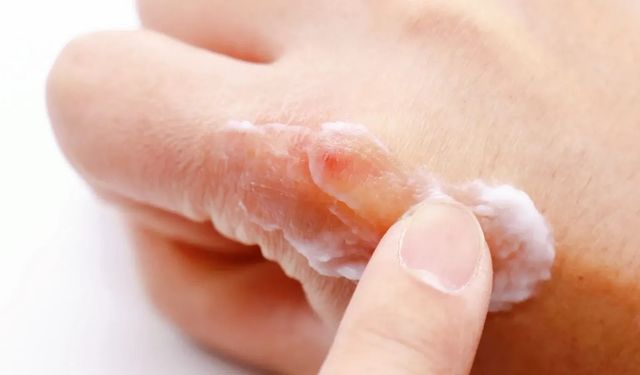 Uzman isimden soğuklarda cilt kuruluğuna karşı 10 tavsiye