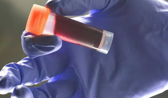 Kan grubunuz erken yaşta inme riskinizi etkiliyor