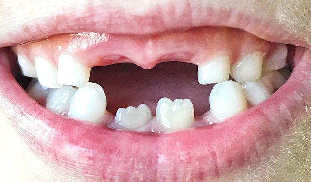 Dişleriniz erken ölüp ölmeyeceğinizi haber veriyor