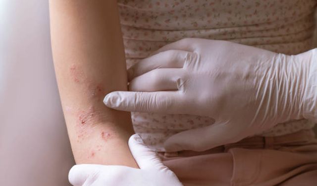 Egzama nedir, neden olur? Egzama bulaşıcı mı?