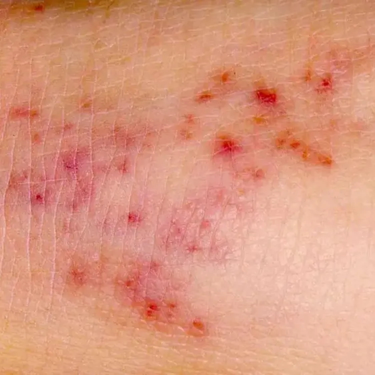 Korkutan Menenjit Yayılımı: Can Kayıpları Artıyor, Vakalar Tırmanışta