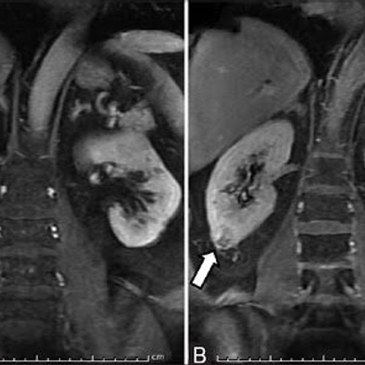 Nefes darlığı şikayetiyle gitti: 8 buçuk kilo tümörle böbreği alındı!