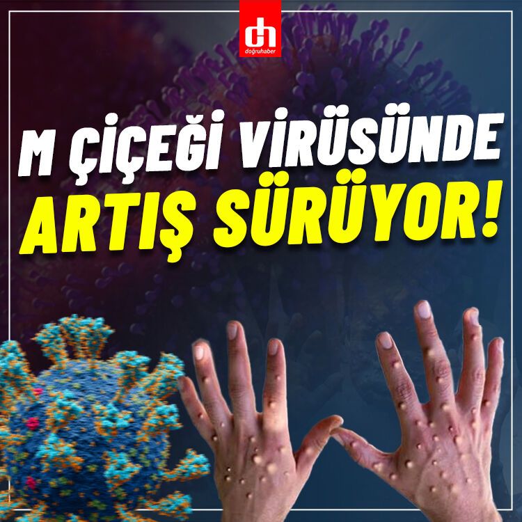 Bir Afrika Ülkesinde M çiçeği Vakalarında Artış!