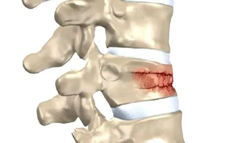 Omurga kırıkları kış aylarında neden artıyor? Uzman isim yanıtladı