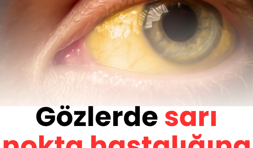 Gözlerde sarı nokta hastalığına dikkat!