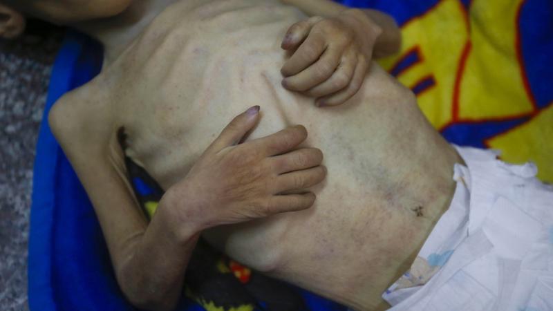 Gazze Aclik Aa 2381767 1